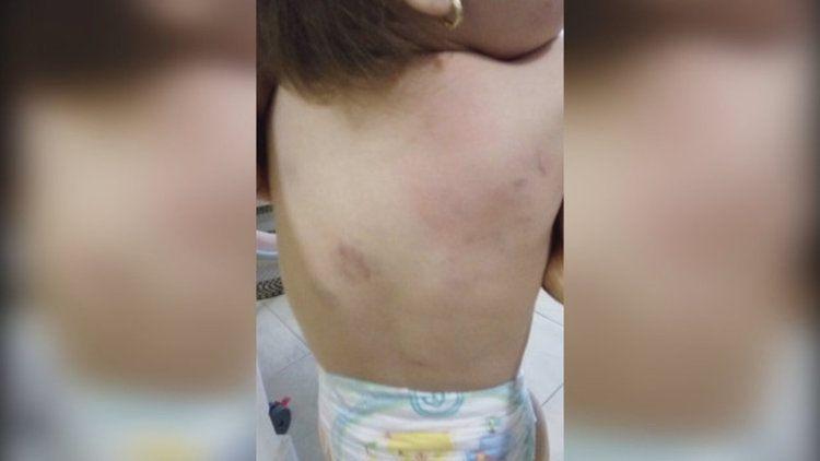 Проверяват детска градина в Бургас заради нахапано дете